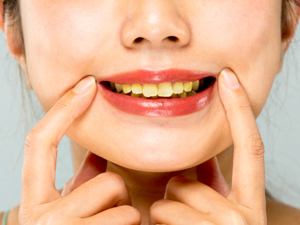 歯の黄ばみの原因は？簡単セルフケアを歯科医が解説！