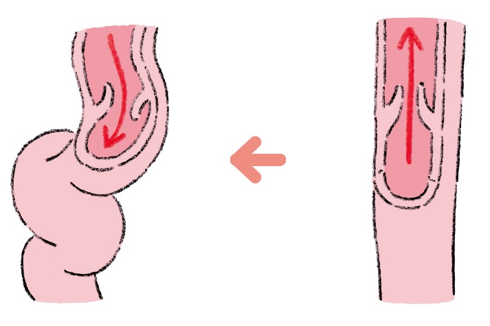 弁が壊れることで下肢静脈瘤は起こる