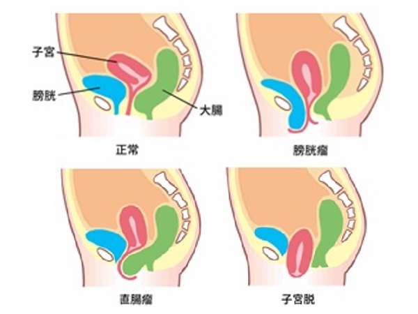 「骨盤臓器脱」ってどんな病気？