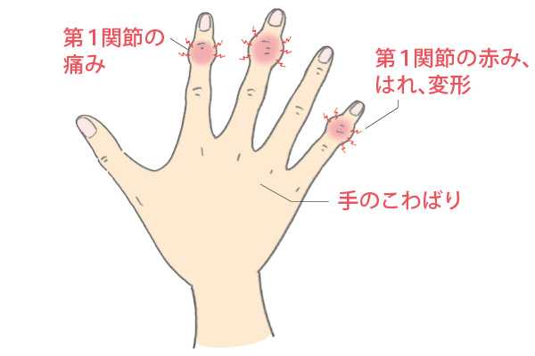 手指の痛み・変形の背景にあるヘバーデン結節