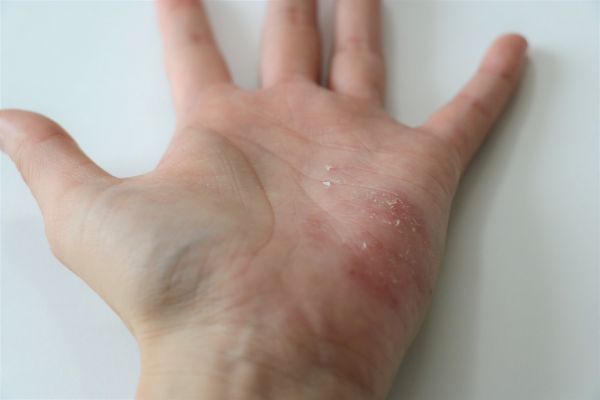 職業病や女性に多い「手湿疹」について