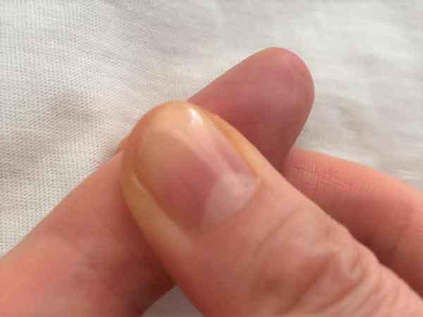 指先の血色で簡単に診断する方法
