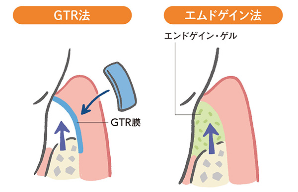 GTR法