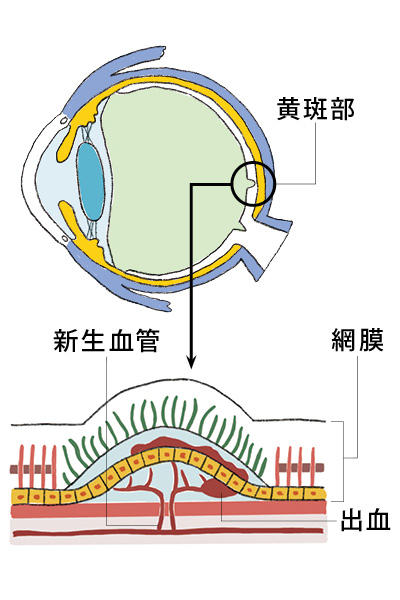 網膜の「黄斑部」に変性が起きる病気です