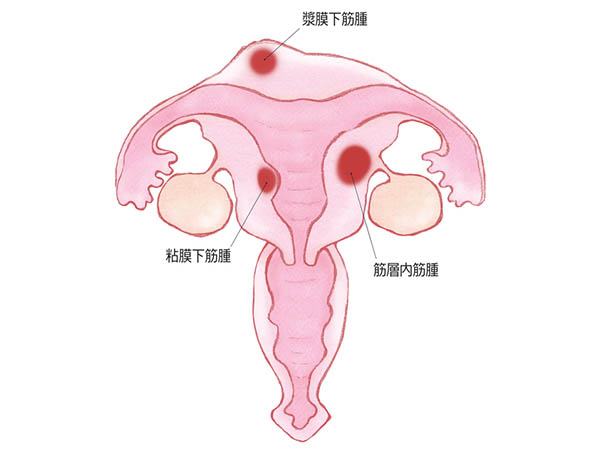 子宮筋腫の分類