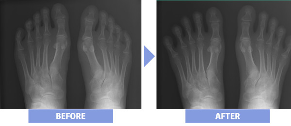 治療ビフォーアフター：足指のばしと靴下で足裏の痛みを改善！