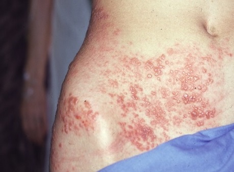 帯状疱疹：皮膚のかぶれと勘違いする人も