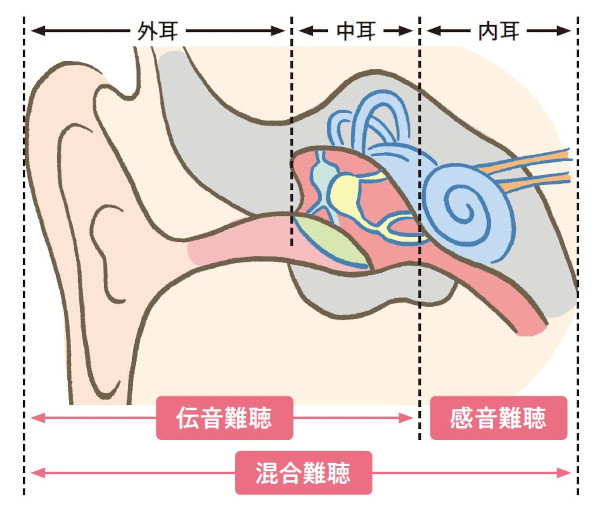 難聴は大きく3つの種類に分けられる