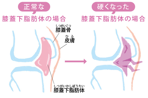 ひざ痛の一番の原因は「ひざのお皿の下」にあった！