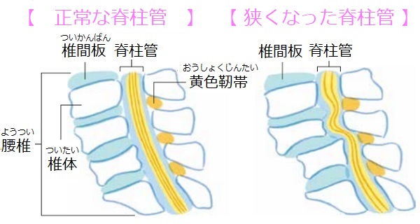 脊柱管　比較イラスト
