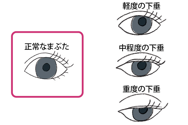 「眼瞼下垂」をセルフチェック！