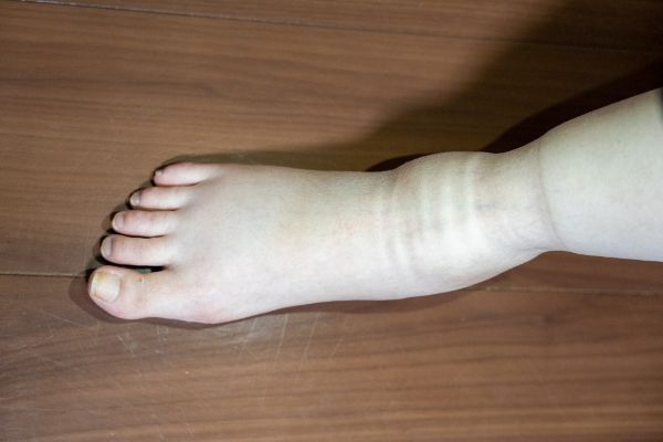 足のむくみが見られる病気