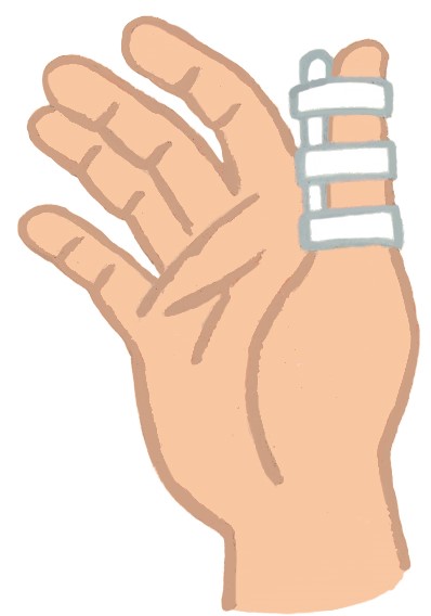腱鞘炎1：ばね指