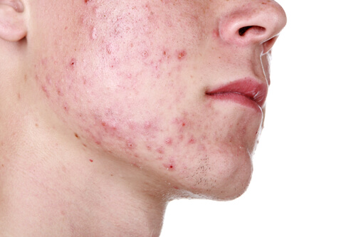 赤ら顔を解消する方法。 7. ニキビや乾燥、皮膚炎などによる炎症