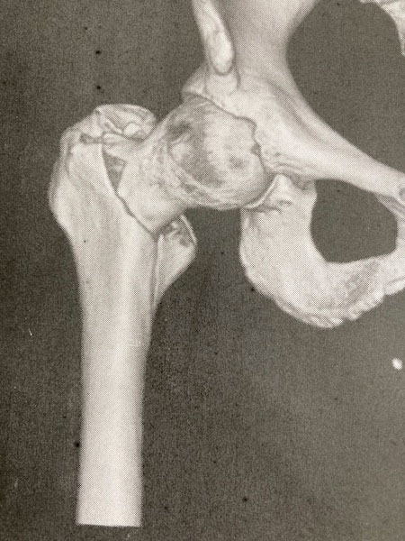 右大腿骨転子部骨折