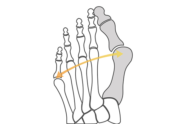 靭帯性外反母趾