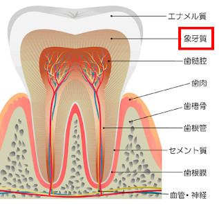 歯の黄ばみの原因：エナメル質が削れ、象牙質が濃く見えるため