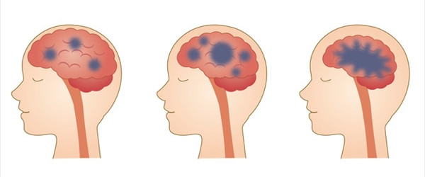 アミロイドβ発生は脳の防御反応