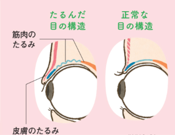 眼瞼下垂・眼瞼皮膚弛緩症の構造