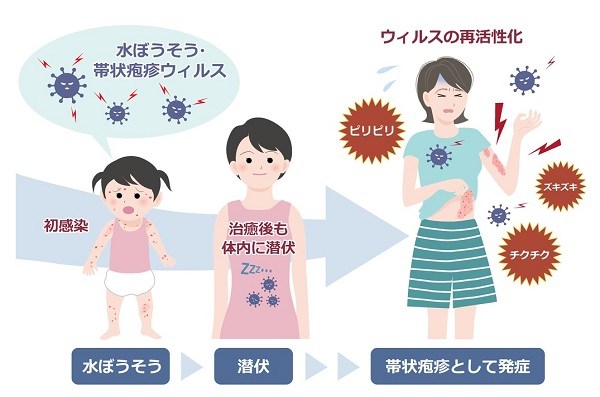 水疱瘡（みずぼうそう）のウイルスが原因で帯状疱疹に